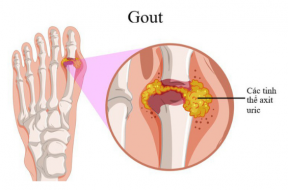 benh-gout