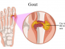 benh-gout